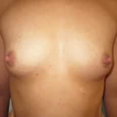 breast implants before