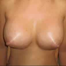 breast implants after