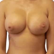breast augmentation after