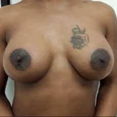 breast enlargement after