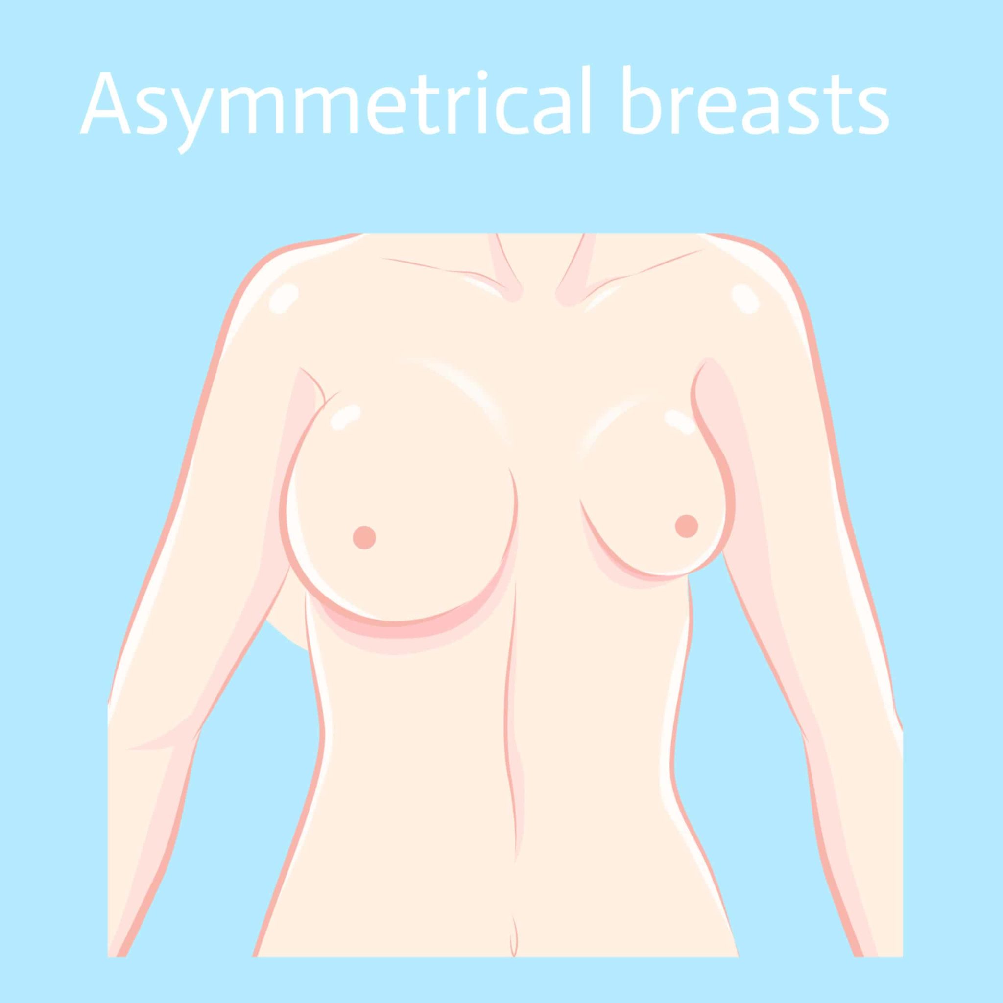 asymmetrical breasts