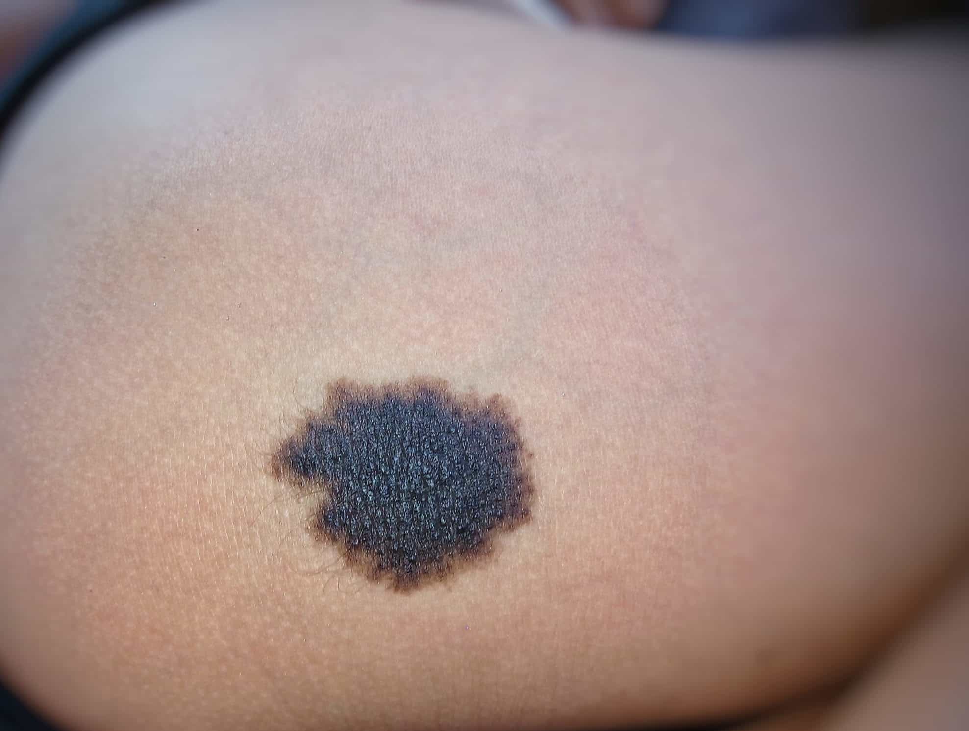 What does a breast cancer mole look like