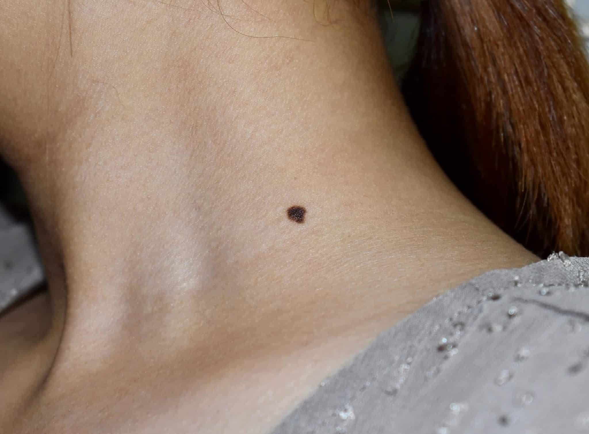 What does a breast cancer mole look like
