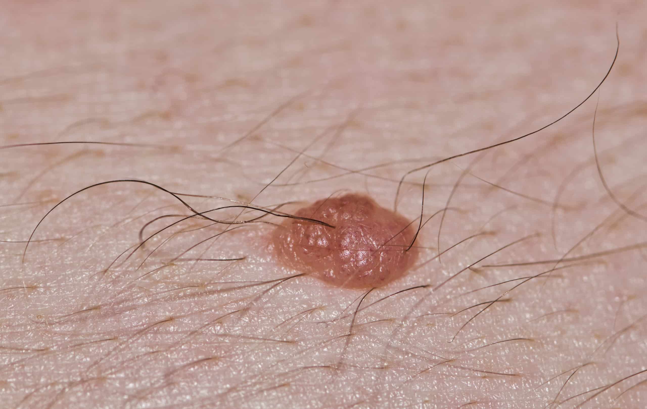 The mole guide: what does a cancerous mole look like? - Harley Medical Group