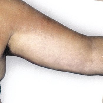 Arm Lift Surgery For Women, Thigh Lift Surgery