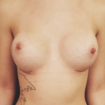 Breast enlargement before and after