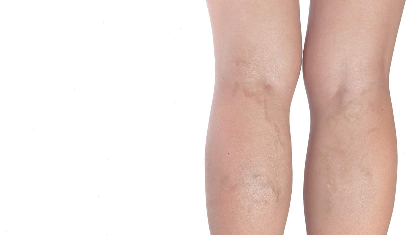 varicose vein removal Manchester