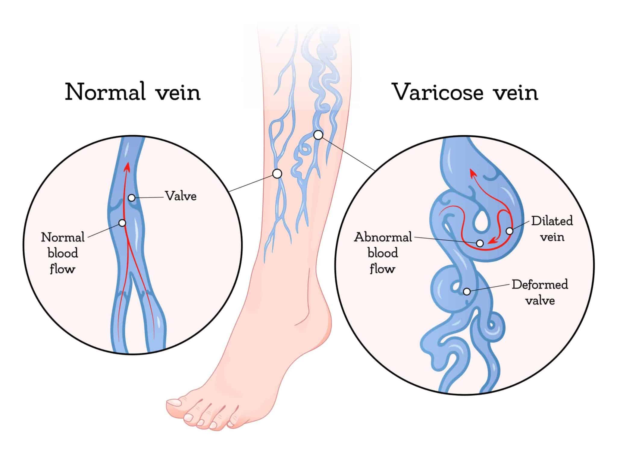 varicose veins illustration