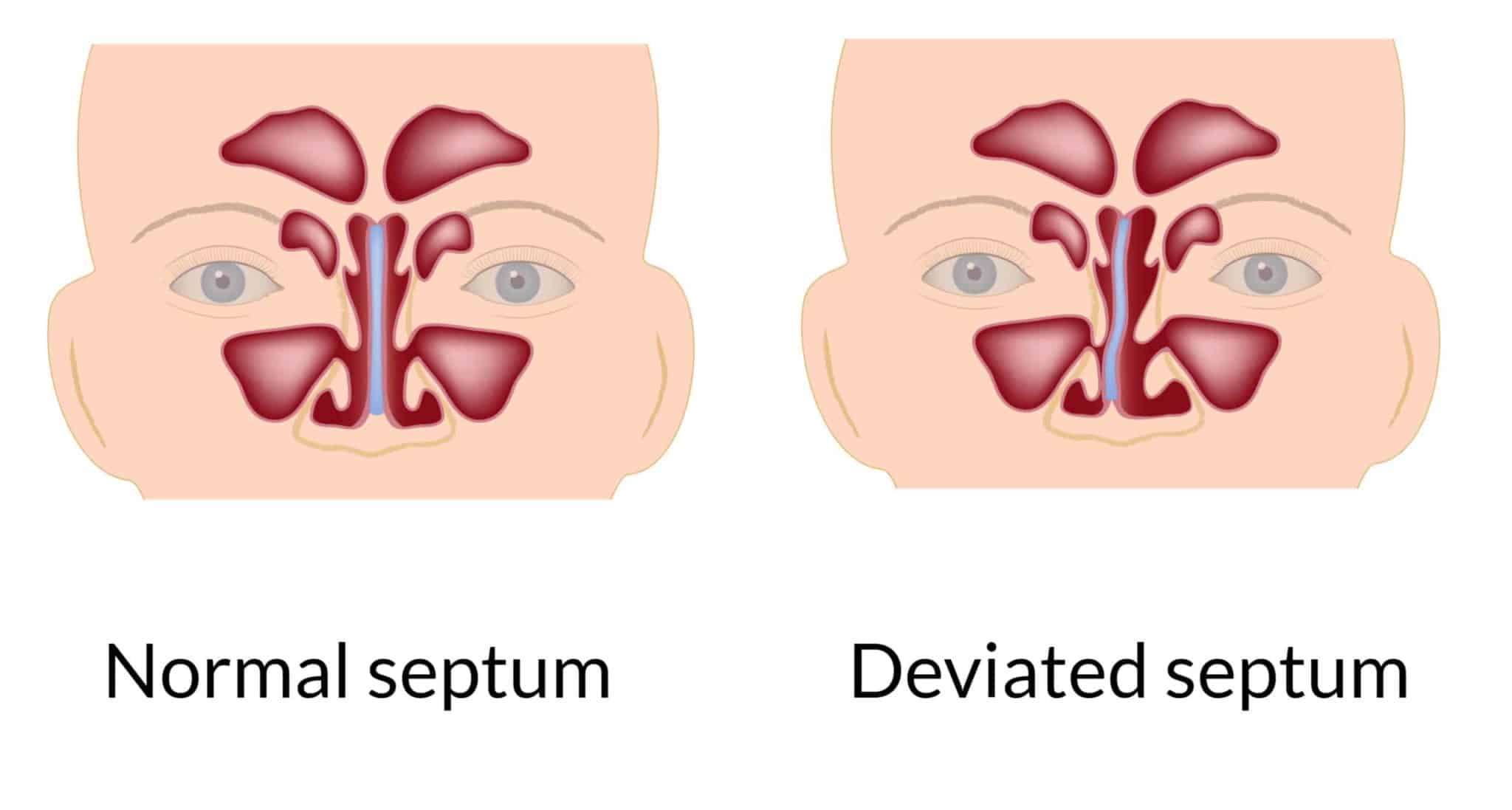 deviated septum