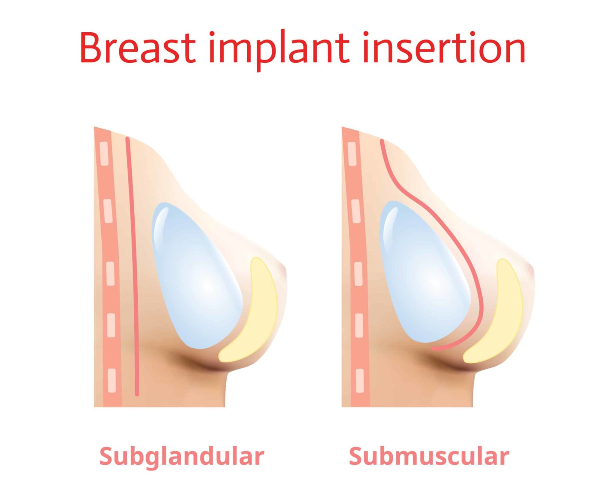 breast implant insertion