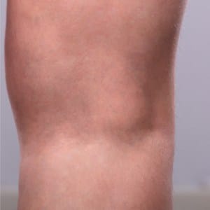 sclerotherapy after