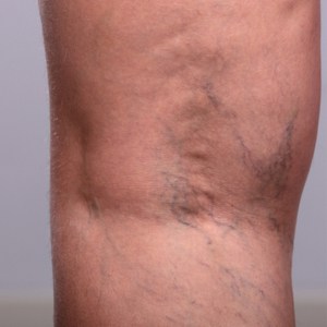 sclerotherapy before