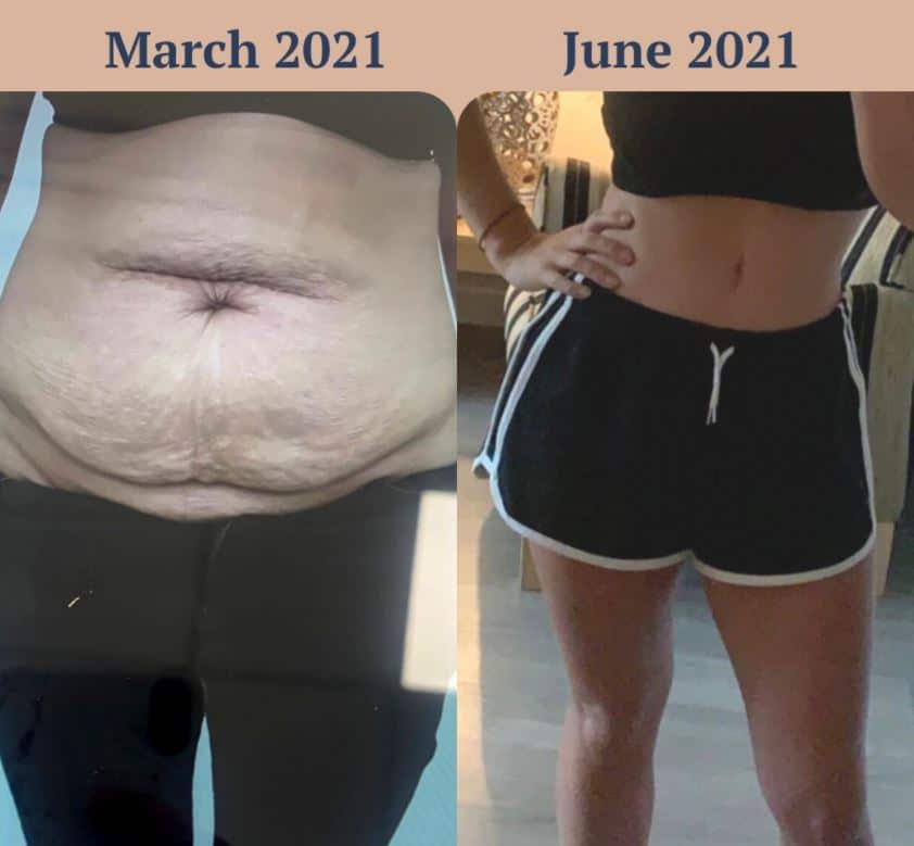 tummy tuck and liposuction before and after