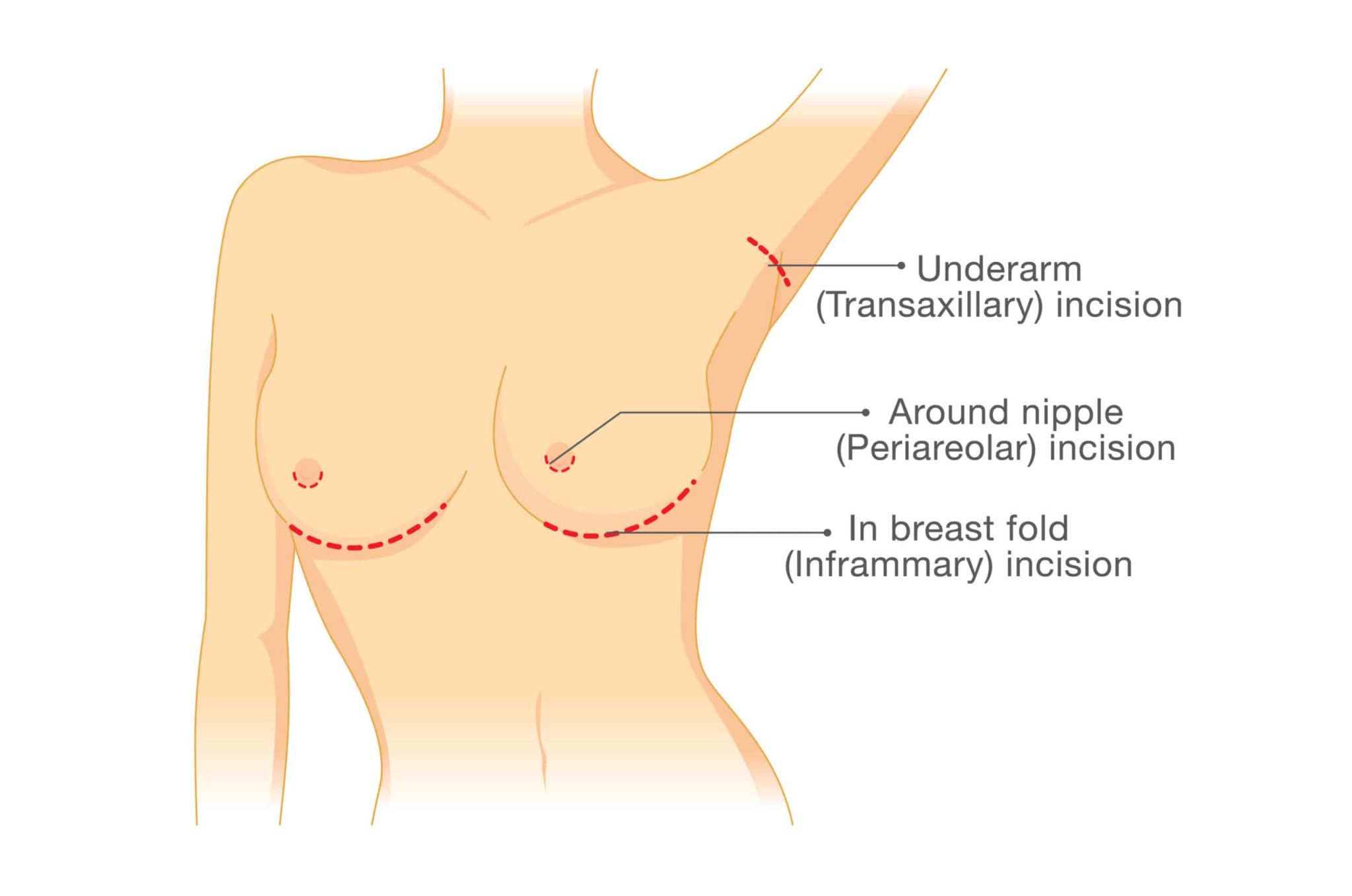 breast augmentation incision types