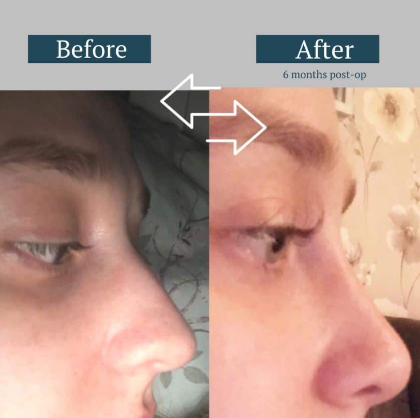 rhinoplasty before and after, patient results, nose job, rhinoplasty recovery