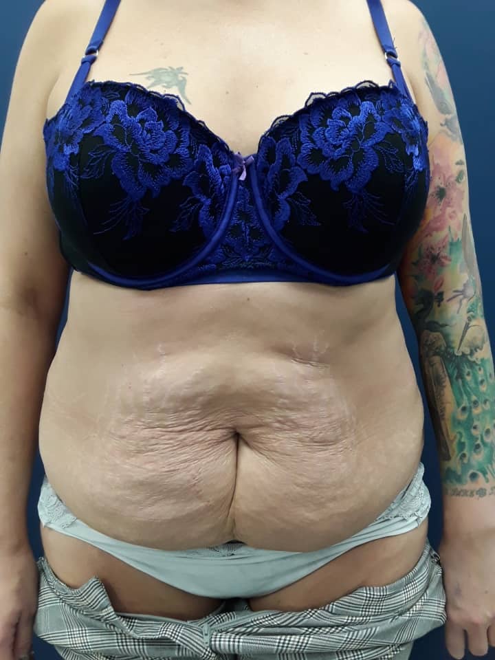 Stomach Liposuction London, Tummy Lipo UK