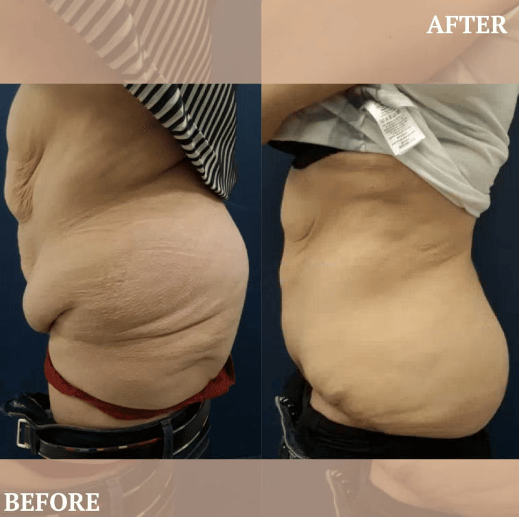 tummy tuck or liposuction, before and after surgery