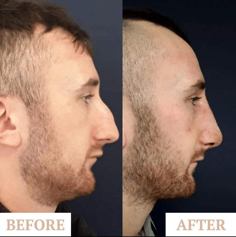 rhinoplasty patient before & after by Mr Premjit Randhawa. Difference between surgical and non-surgical rhinoplasty. Choosing surgical or non-surgical rhinoplasty. 