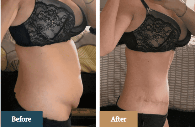 Can you have a Tummy Tuck after a C-Section?