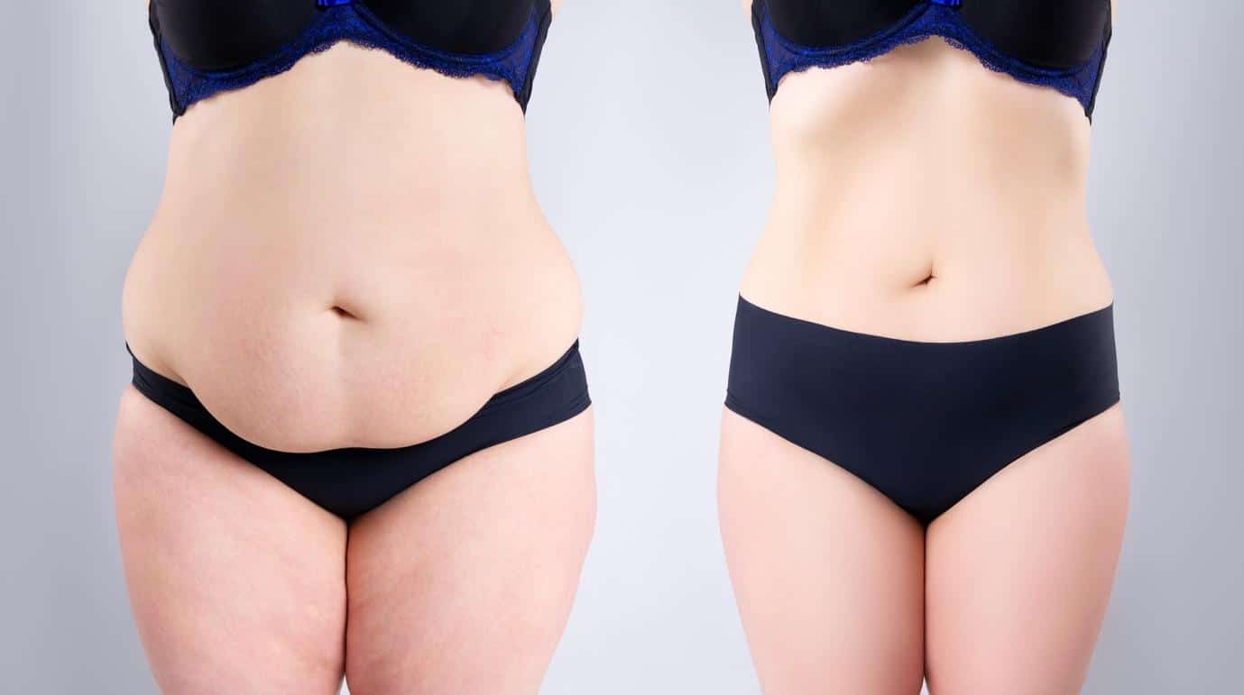 is a tummy tuck safe? abdominoplasty surgery before and after