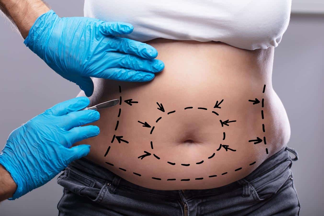 what is a tummy tuck?