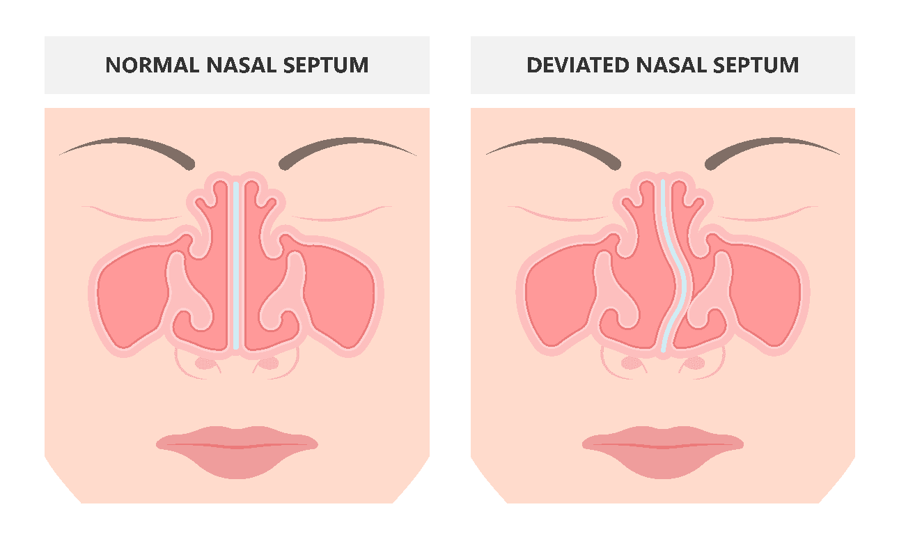 deviated septum, deviated septum surgery, nasal septum cartoon, infographic, diagram